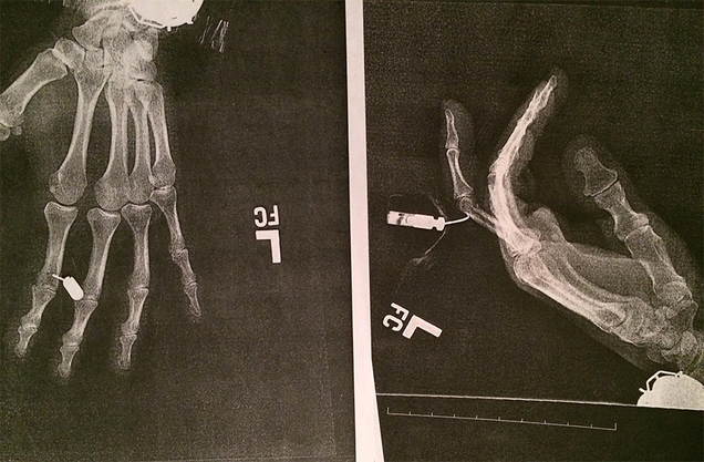 X-rays of Ross’s tased hand